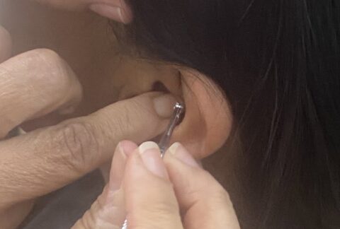 Auriculoterapia